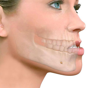 Prognatismo mandibular